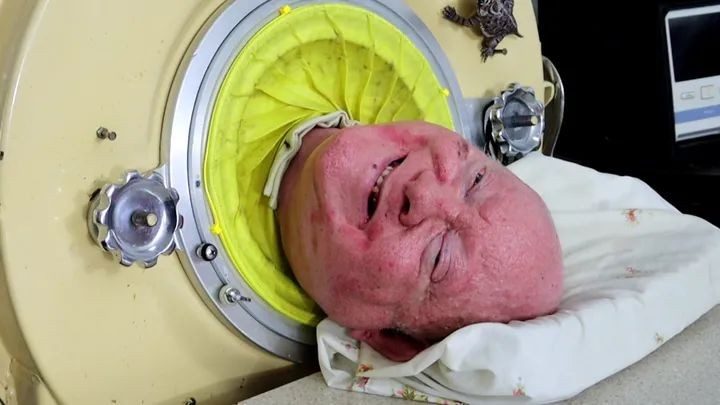 Chứng tá Kitô của ông Paul Alexander, 72 năm sống trong một lá phổi sắt